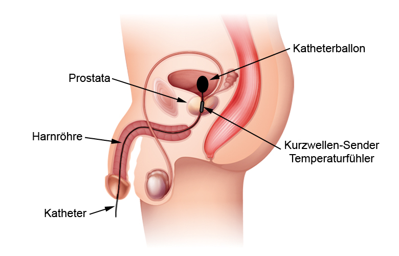  Transurethrale Hyperthermie bei Prostatakarzinom - Ablauf